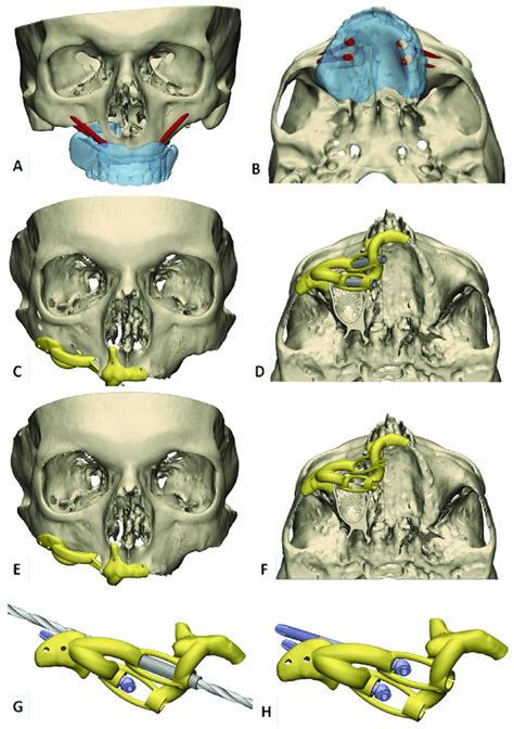 Overview Of D Vsp Workflow For Virtual Zygomatic Implant Planning