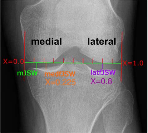 Figure 1 From The Contribution Of 3d Quantitative Meniscal And