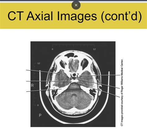 Ct Axial Image 10 Diagram Quizlet