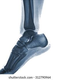 Xray Normal Human Foot Lateral View Stock Photo Shutterstock