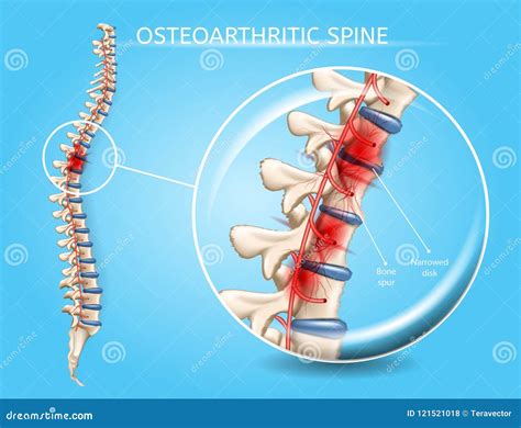 Spinal Osteoarthritis Realistic Vector Concept | CartoonDealer.com ...