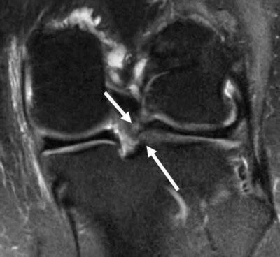 Lateral Meniscus Tear | Complex Knee Surgeon | Minnesota