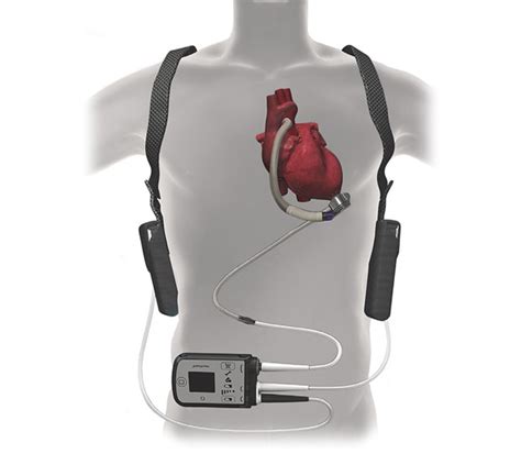 Ventricular Assist Device