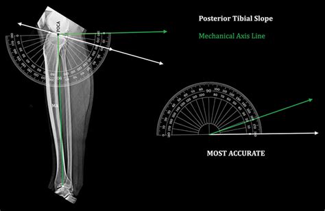 A Novel Precision Technique For Preoperative Planning Of Posterior