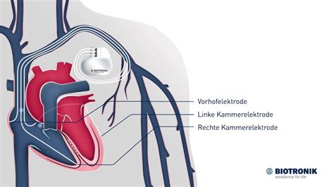 Crt Therapie Bei Herzschwäche Animation Medizin Youtube