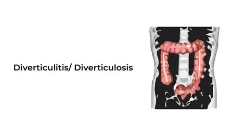 Understanding Diverticulitis Diverticulosis ~ Healthcare City