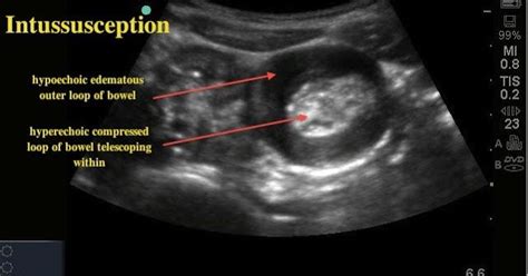 MEDICAL ULTRASOUND INTUSSUSCEPTION