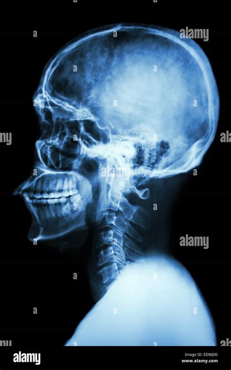 Radiografía del cuello de vértebras cervicales immagini e fotografie