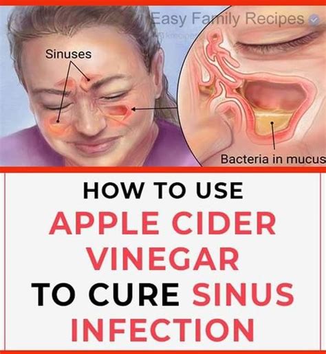 Pin By Lois Price On Health Advice Sinusitis Sinus Infection How To