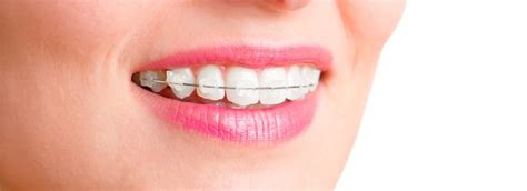 How Much Do Braces Cost For Adults Healthguide Tip