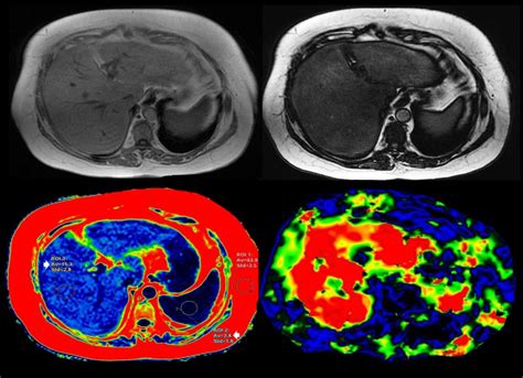 Nuevo equipo de elastografía por Resonancia Magnética en el GIBI230