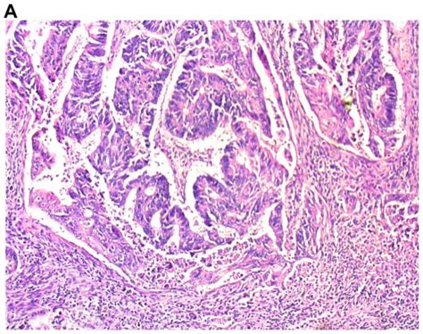 Tumorinfiltrating Lymphocytes In Primary Tumors Of Colorectal Cancer