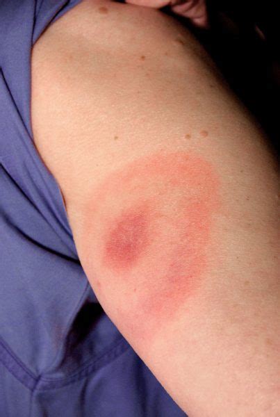 Erythema Marginatum: Causes, Picture, Symptoms And Treatment