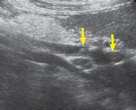 Sonogram Of The Common Bile Duct Depicts Curvilinear Echogenic Download Scientific Diagram