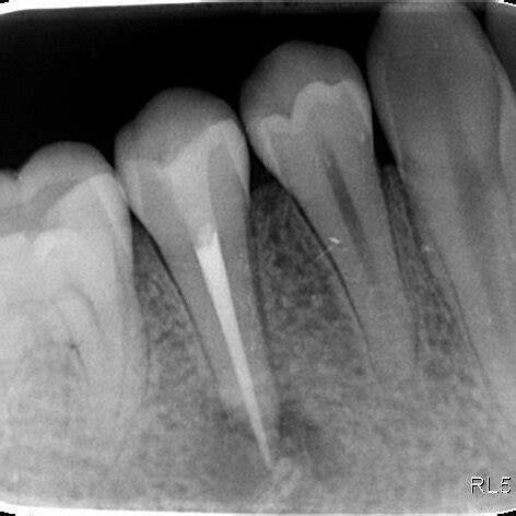 Radiograph Revealing Periapical Radiolucency Around Tooth 29