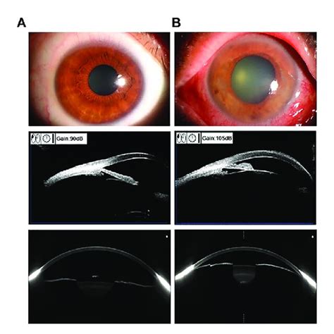 Using Anterior Segment OCT AS OCT In Comparison With Other Imaging Of