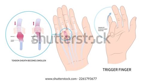 Palm Lump Muscle Examine Hand Cyst Stock Vector (Royalty Free ...