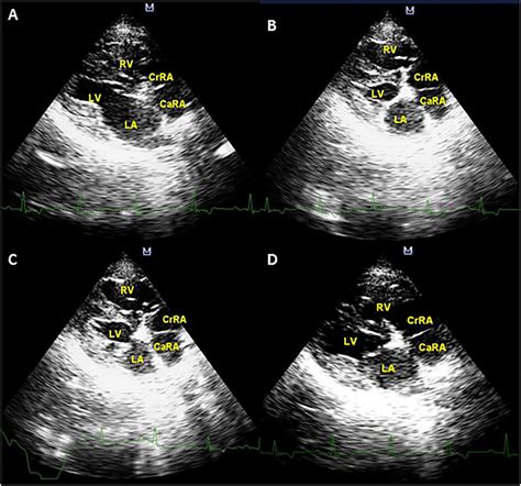bidimensional  echocardiogram    parasternal long axis