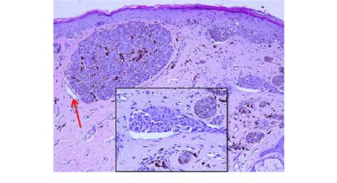 Case 2 Biopsy Showing A Superficial Spreading Melanoma In Vertical