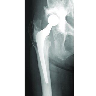 Plain X-ray images after re-revision total hip arthroplasty. The ...