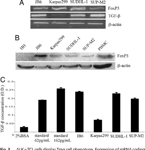 Figure 3 From Nucleophosmin Anaplastic Lymphoma Kinase NPM ALK