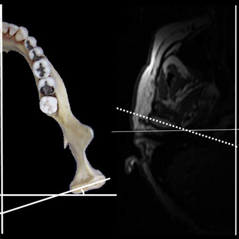 The horizontal angle of the condyle on a mandible (A) and on an MRI (B). | Download Scientific ...