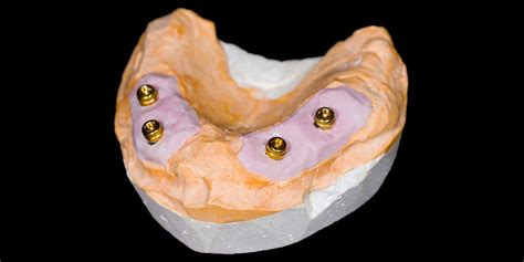 full arch   implants dental implants