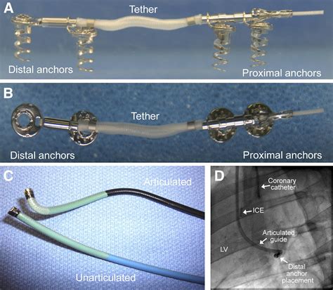 A Novel Method Of Percutaneous Mitral Valve Repair For Ischemic Mitral