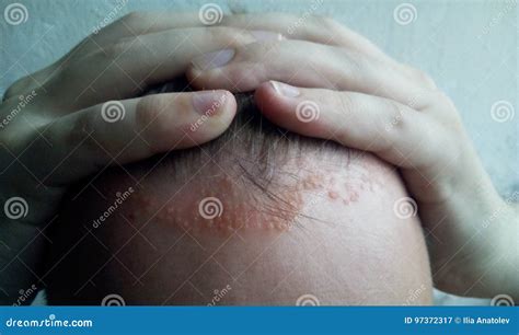 Psoriasis On The Skin Close Up Scalp Photos Of Dermatitis And Eczema