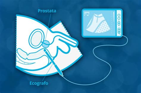 Ecografia Prostatica Transrettale Ecorad