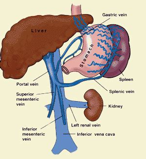 Portal Vein Thrombosis: Causes and Treatments Explained - EnkiVillage