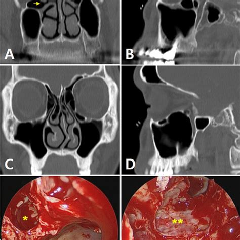 Axial ( ) and Coronal ( ) scans of mucus retention cyst. –mucosal... | Download Scientific Diagram