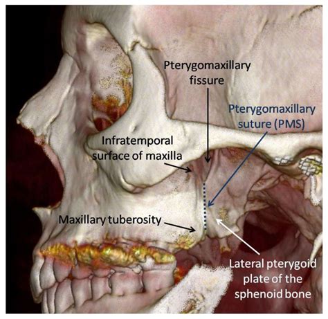 Lateral Pterygoid Plate Of Sphenoid Bone