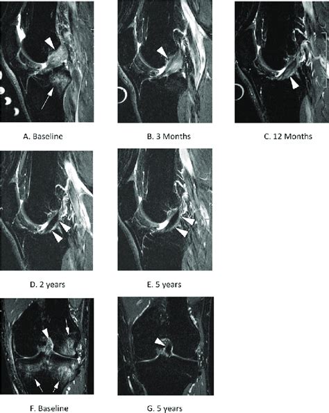 Evidence of ACL healing on MRI over 5 years in a KANON study ...