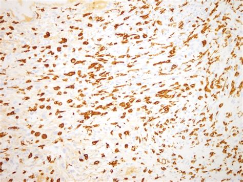 Pleomorphic Dermal Sarcoma Dermatopathology