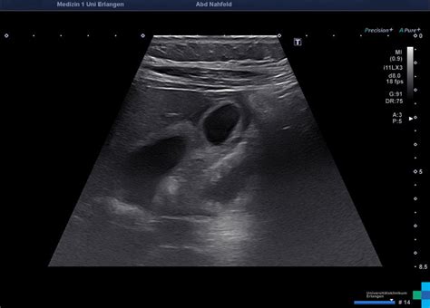 Adenomyomatose Sonographieatlas Erlangen