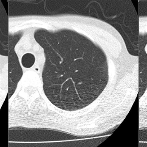 A Solid 5 Mm Nodule In The Left Upper Lobe Is Depicted In The Original Download Scientific