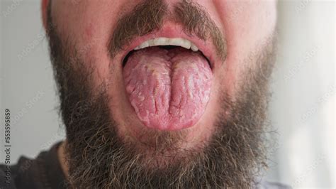 Foto Stock Geographic Tongue Disease Candidiasis Tongue Inflammatory