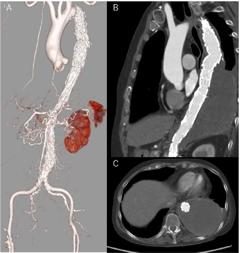 A Postoperative 3d Ct Finding B Postoperative Ct In The Sagital View Download Scientific