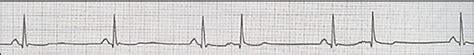 Diagnostic Approach To Palpitations Aafp