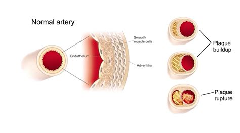 What is Chronic Inflammation, and Why Is It Killing Us?