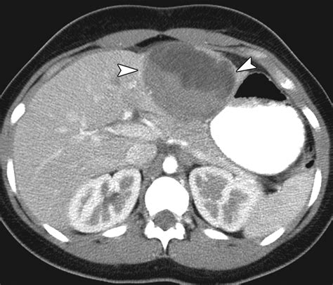 Pediatric Liver Masses Radiologic Pathologic Correlation Part 1