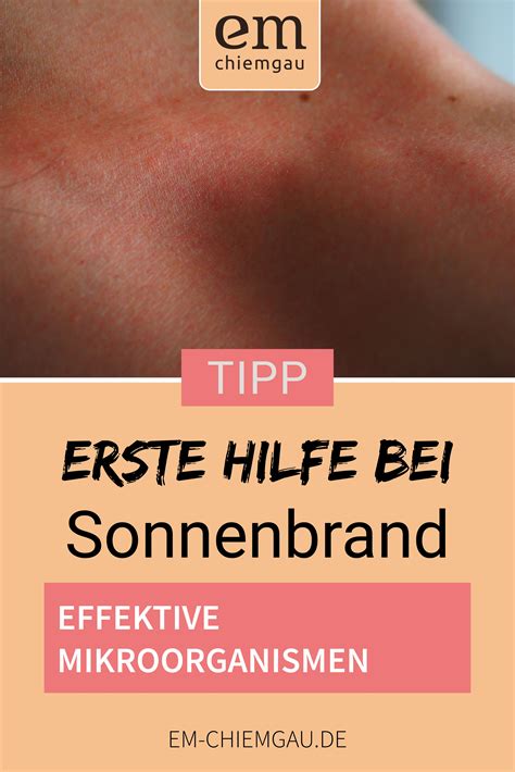 Erste Hilfe Bei Sonnenbrand Mit Mikroorganismen Deine Reiseapotheke