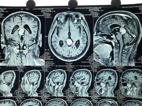 MRI brain showing pineal region tumor. | Download Scientific Diagram