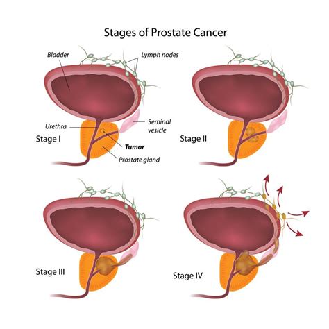 Prostate Cancer Diagnosis And Treatment La Plata Urologist