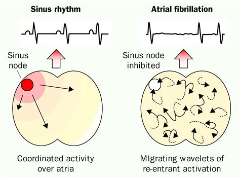 Atrial Fibrillation The Lancet