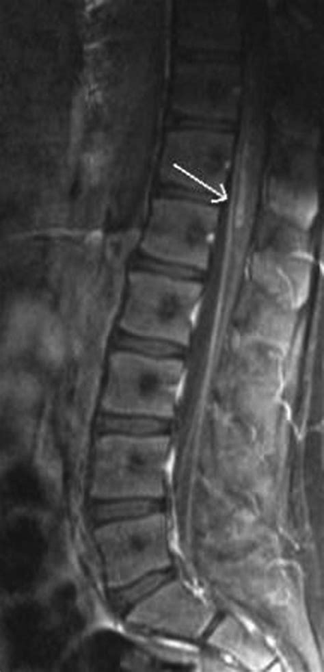 832 Acute Transverse Myelitis In A Pediatric Case Of Lyme Disease