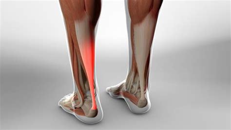 Achilles Tendon Lengthening Percutaneous Method