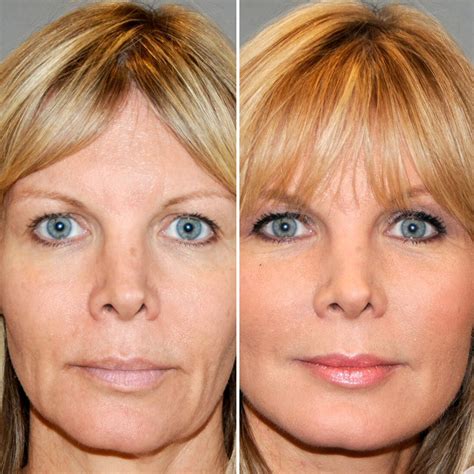 Appeal At Every Age Face Contouring Therapies