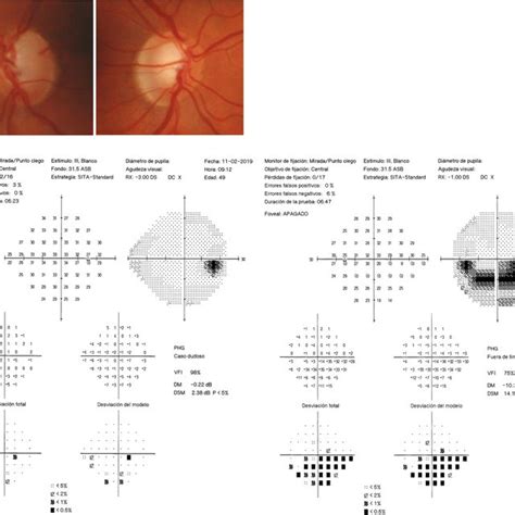 Normal Intraocular Pressure Iop Values In Diurnal Iop Curve Without